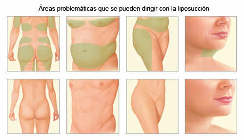 Liposuccion - my plastic surgeon in mexico