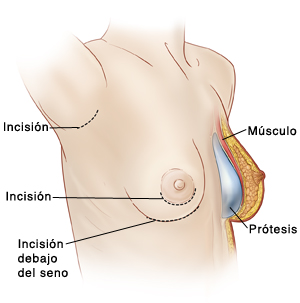 implante mamario - my plastic surgeon in mexico